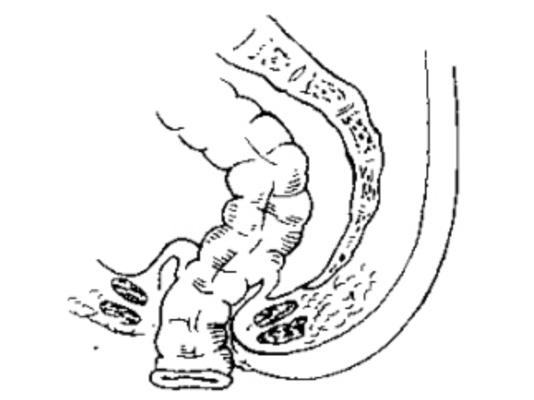 改良Bacon 手术(改良拖出术).jpg 改良Bacon 手术(改良拖出术).jpg