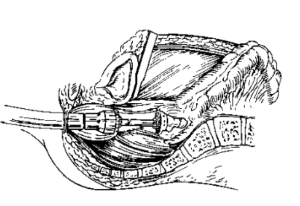 Dixon 手术(双吻合器法经腹前切除术).jpg Dixon 手术(双吻合器法经腹前切除术).jpg